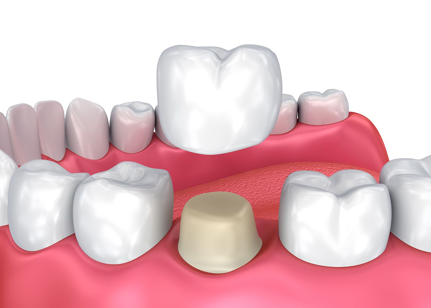Dental crown